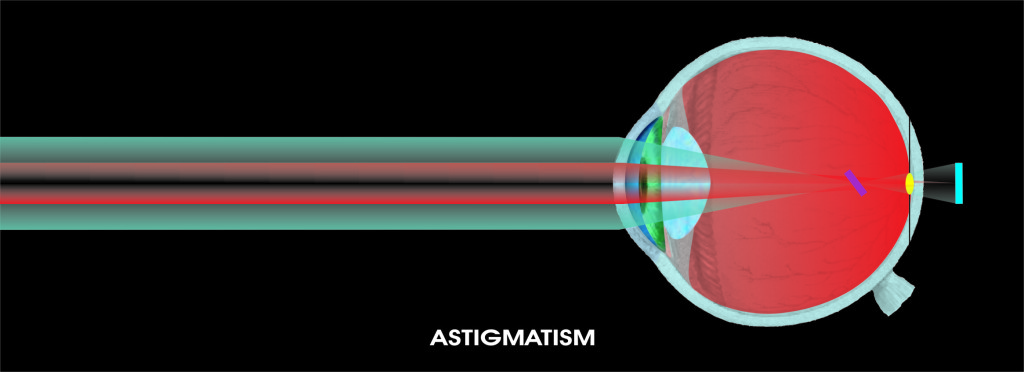Astigmatism ochi uman