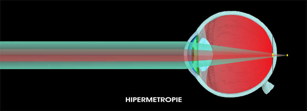 Hipermetropia ochiului