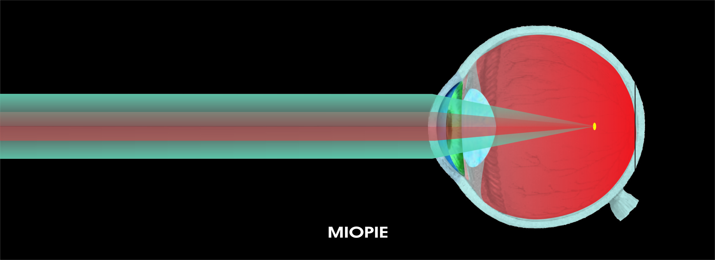 cum se poate măsura miopia